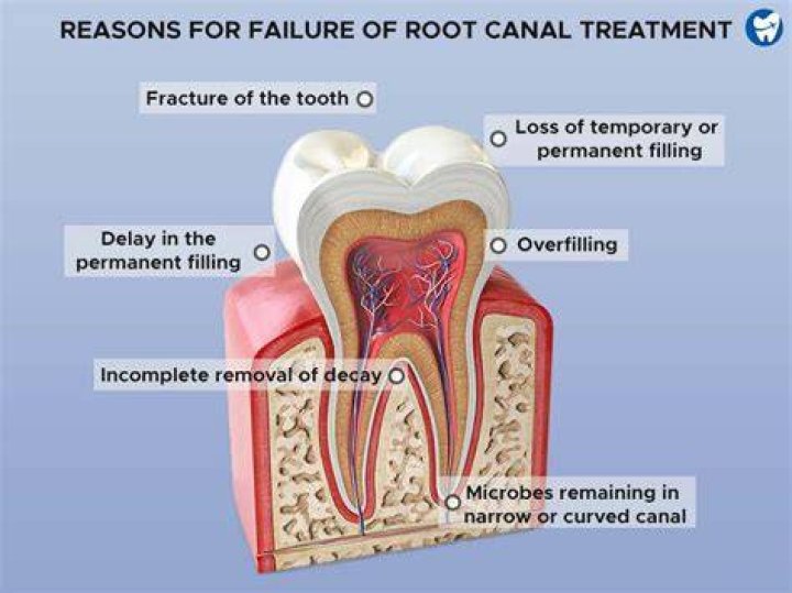 Can antibiotics fix a failed root canal?