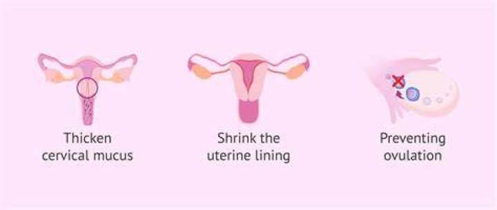 Can IUD cause depression?