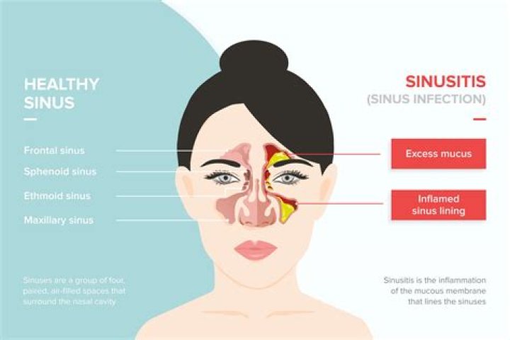Can sinus rinses cause infection?