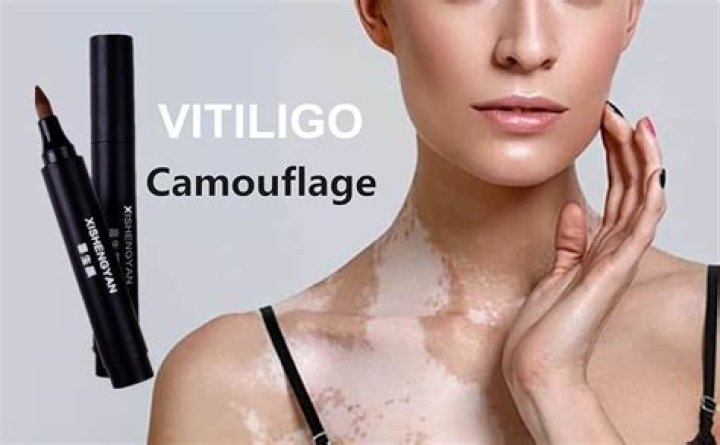 Does concealer cover vitiligo?