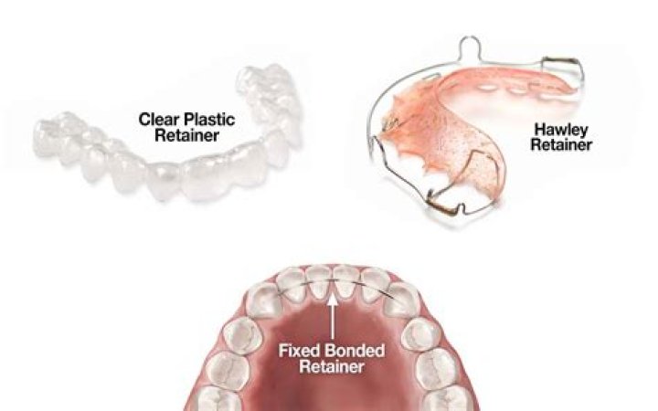 How do you take care of a plastic retainer?