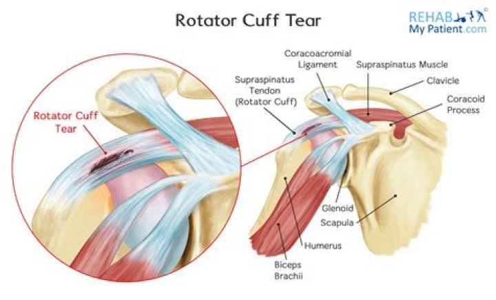 How do you tell if your rotator cuff is torn or strained?