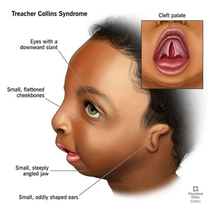 What causes Treacher Collins syndrome?