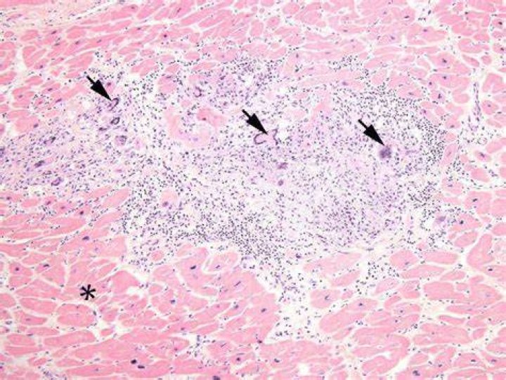What do sarcoid granulomas look like?