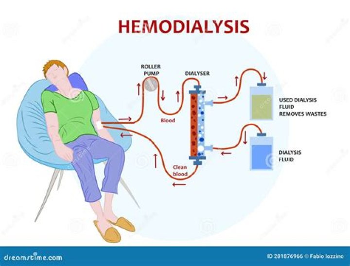 What is the longest someone has been on dialysis?