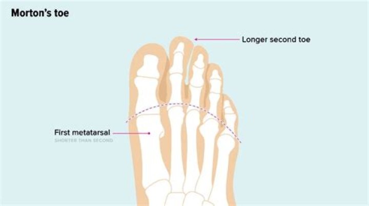 Why is my second toe so long?
